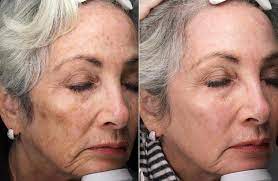 Alastin Skincre Before and After