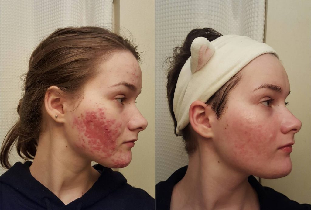 CeraVe Acne Control Gel before and after