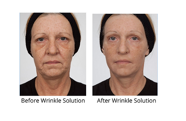 Dr. Sevinor Wrinkle Solution before and after