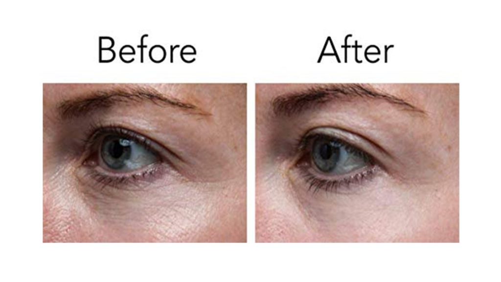 Anti-Wrinkle Eye Cream before and after